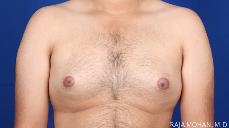 Gynecomastia Before & After Gallery - Patient 175963 - Image 51