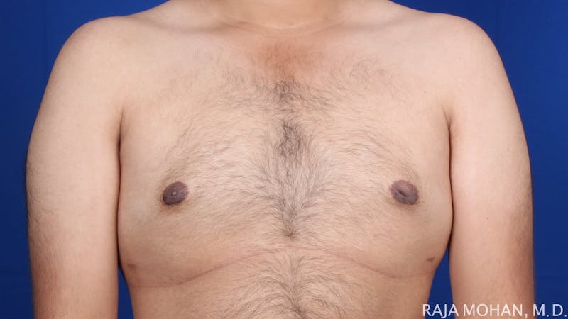Gynecomastia Before & After Gallery - Patient 175963 - Image 52