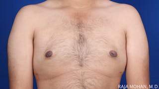 Gynecomastia Before & After Gallery - Patient 175963 - Image 52