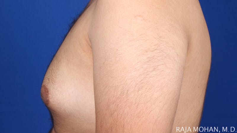 Gynecomastia Before & After Gallery - Patient 175963 - Image 53