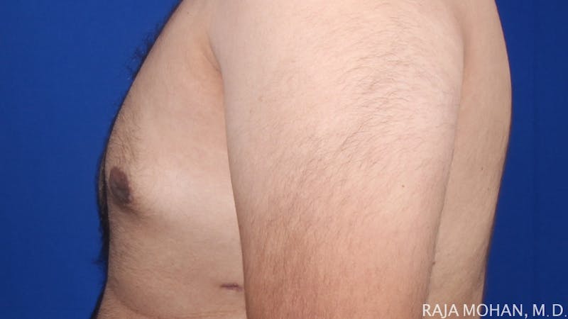 Gynecomastia Before & After Gallery - Patient 175963 - Image 54