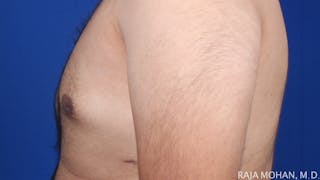 Gynecomastia Before & After Gallery - Patient 175963 - Image 54