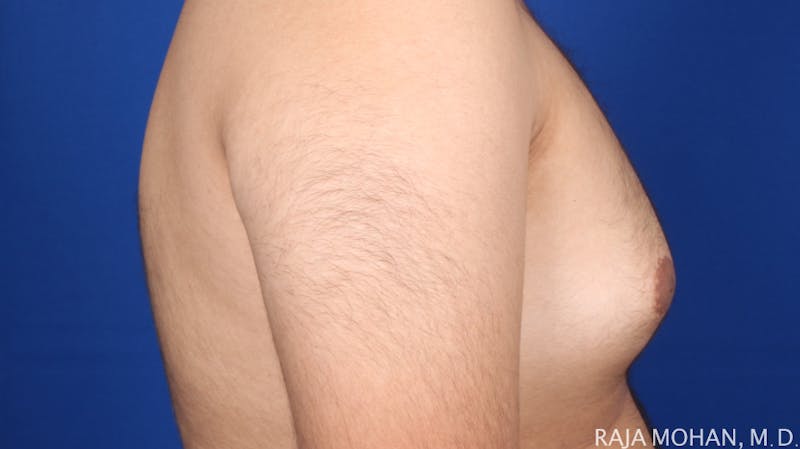Gynecomastia Before & After Gallery - Patient 175963 - Image 57
