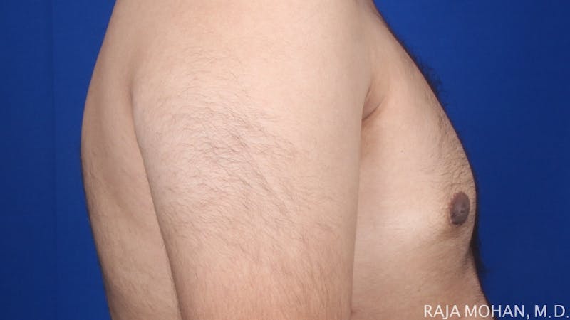 Gynecomastia Before & After Gallery - Patient 175963 - Image 58
