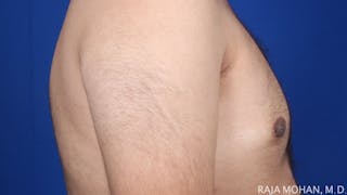 Gynecomastia Before & After Gallery - Patient 175963 - Image 58