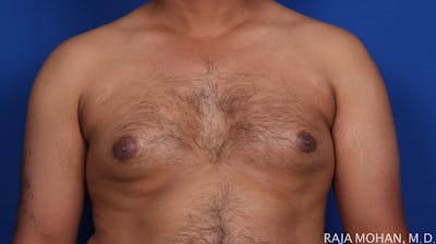 Gynecomastia Before & After Gallery - Patient 231234 - Image 1