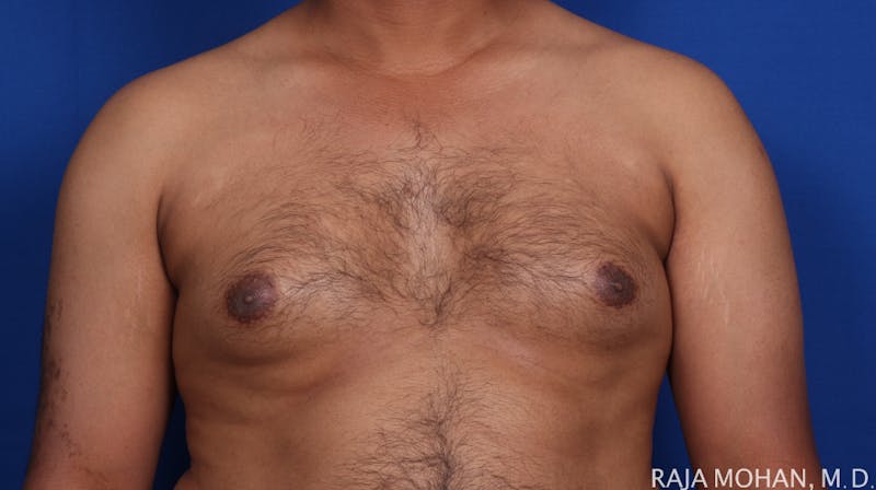 Gynecomastia Before & After Gallery - Patient 175963 - Image 61