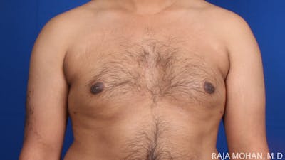 Gynecomastia Before & After Gallery - Patient 231234 - Image 2