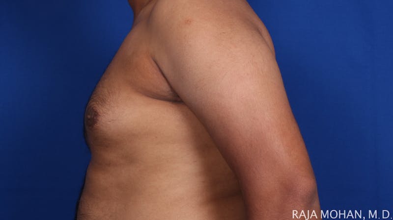 Gynecomastia Before & After Gallery - Patient 175963 - Image 63
