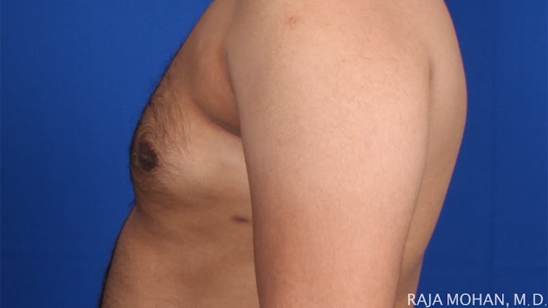 Gynecomastia Before & After Gallery - Patient 175963 - Image 64