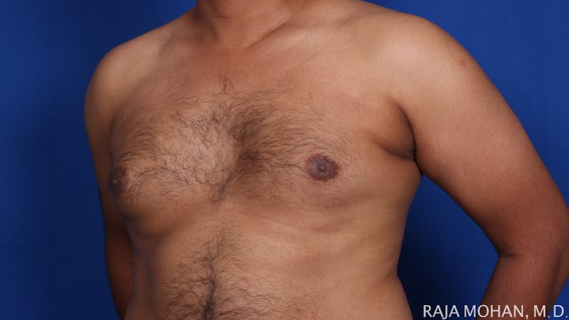 Gynecomastia Before & After Gallery - Patient 175963 - Image 65
