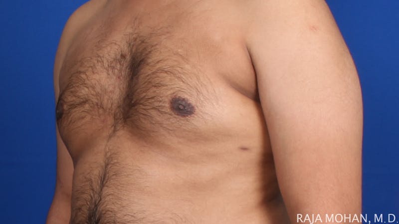 Gynecomastia Before & After Gallery - Patient 175963 - Image 66