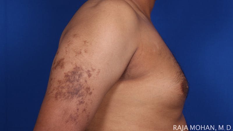 Gynecomastia Before & After Gallery - Patient 175963 - Image 67