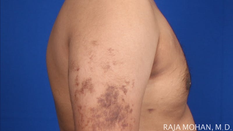 Gynecomastia Before & After Gallery - Patient 175963 - Image 68
