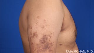 Gynecomastia Before & After Gallery - Patient 175963 - Image 68