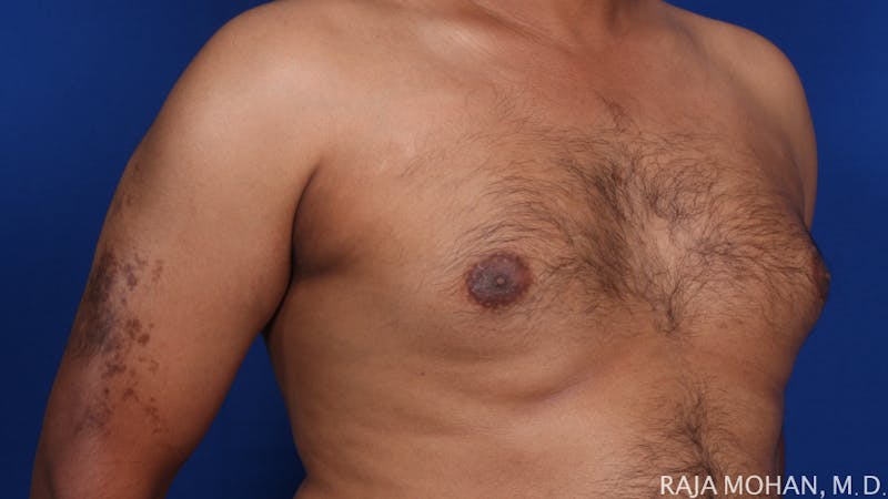 Gynecomastia Before & After Gallery - Patient 175963 - Image 69