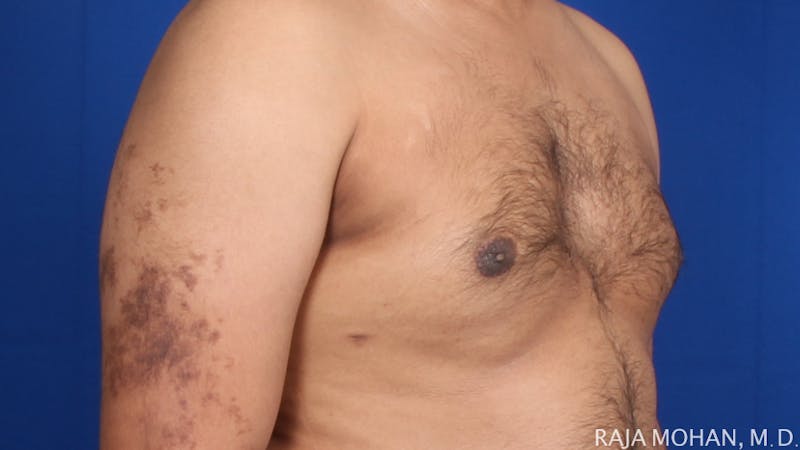 Gynecomastia Before & After Gallery - Patient 175963 - Image 70