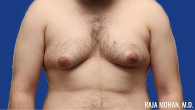 Gynecomastia Before & After Gallery - Patient 377259 - Image 1