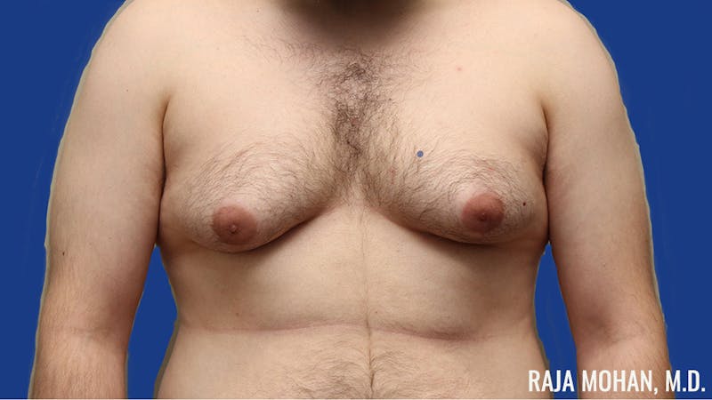 Gynecomastia Before & After Gallery - Patient 377259 - Image 1