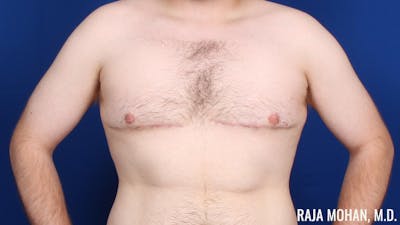 Gynecomastia Before & After Gallery - Patient 377259 - Image 2