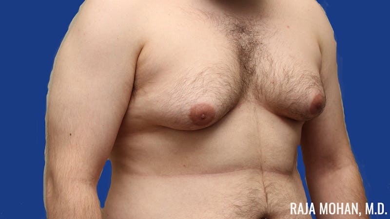 Gynecomastia Before & After Gallery - Patient 377259 - Image 3