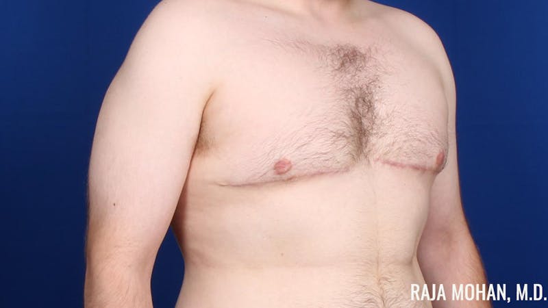 Gynecomastia Before & After Gallery - Patient 377259 - Image 4