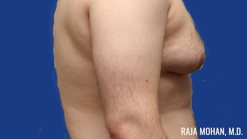 Gynecomastia Before & After Gallery - Patient 377259 - Image 5