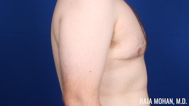 Gynecomastia Before & After Gallery - Patient 377259 - Image 6