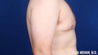 Gynecomastia Before & After Gallery - Patient 377259 - Image 6