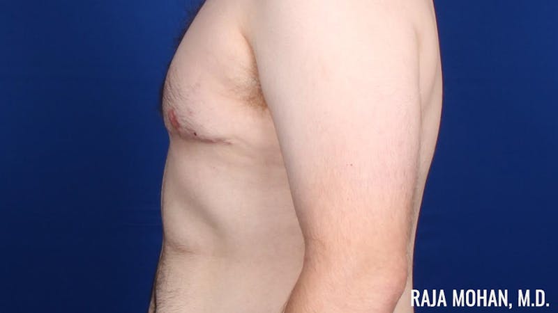 Gynecomastia Before & After Gallery - Patient 377259 - Image 7