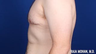Gynecomastia Before & After Gallery - Patient 377259 - Image 8