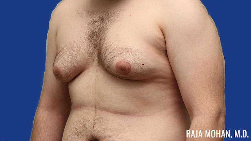 Gynecomastia Before & After Gallery - Patient 377259 - Image 9