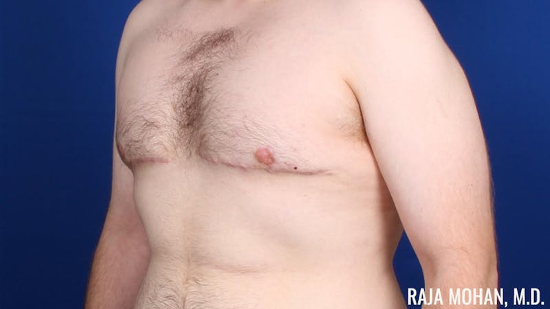 Gynecomastia Before & After Gallery - Patient 377259 - Image 10