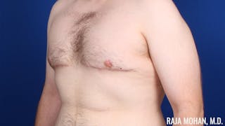 Gynecomastia Before & After Gallery - Patient 377259 - Image 10