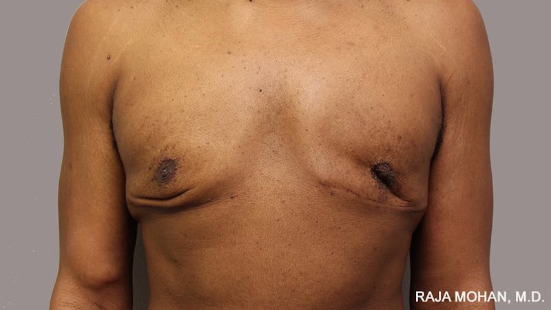 Gynecomastia Before & After Gallery - Patient 175963 - Image 81