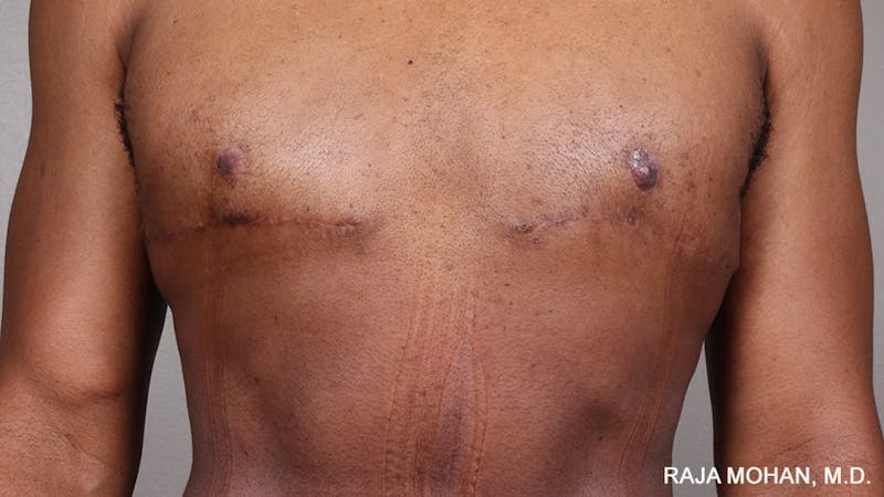 Gynecomastia Before & After Gallery - Patient 175963 - Image 82