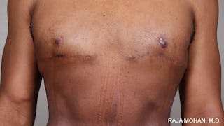 Gynecomastia Before & After Gallery - Patient 175963 - Image 82