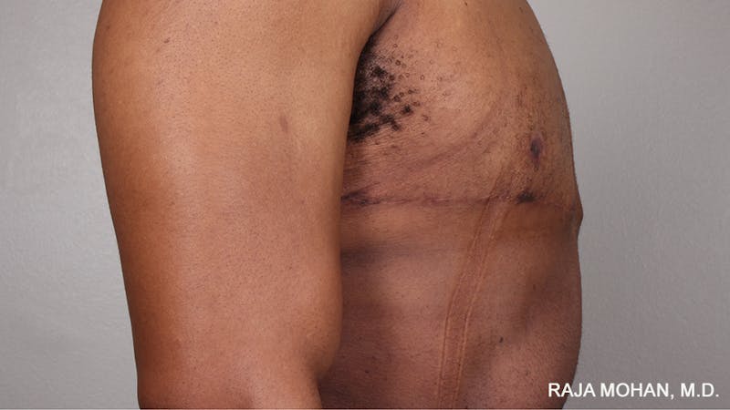Gynecomastia Before & After Gallery - Patient 175963 - Image 84