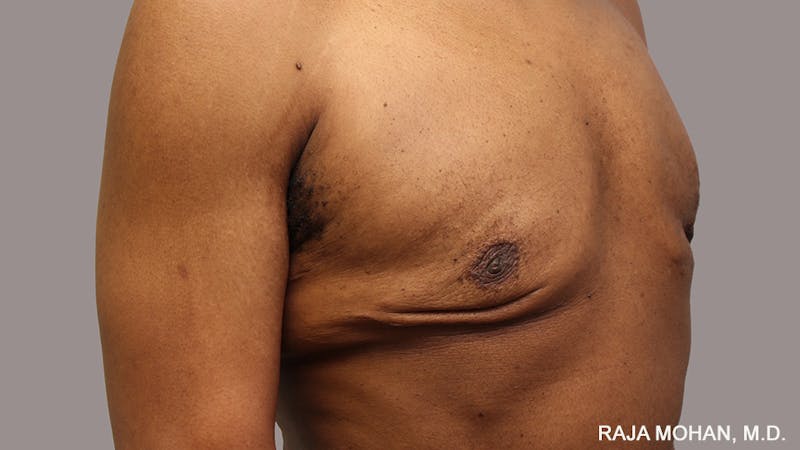 Gynecomastia Before & After Gallery - Patient 175963 - Image 85