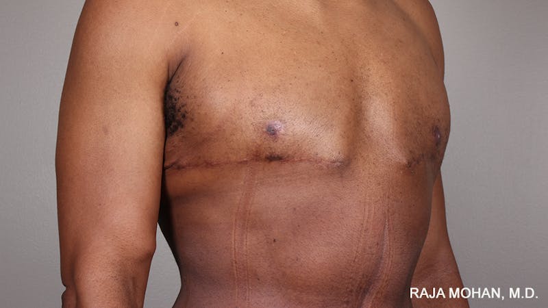 Gynecomastia Before & After Gallery - Patient 175963 - Image 86