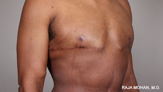 Gynecomastia Before & After Gallery - Patient 175963 - Image 86