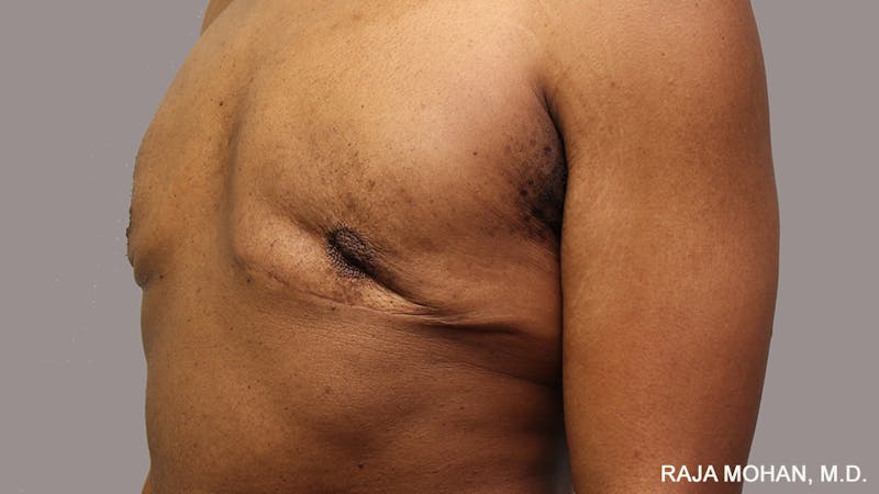 Gynecomastia Before & After Gallery - Patient 175963 - Image 87