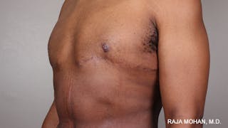 Gynecomastia Before & After Gallery - Patient 175963 - Image 88