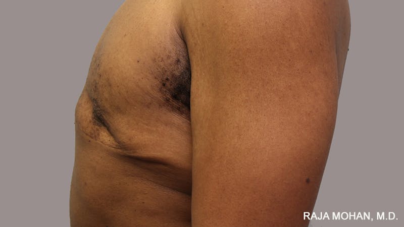 Gynecomastia Before & After Gallery - Patient 175963 - Image 89
