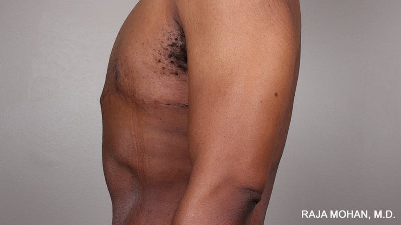 Gynecomastia Before & After Gallery - Patient 175963 - Image 90