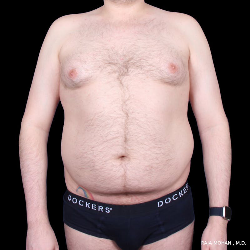 Liposuction Before & After Gallery - Patient 100759 - Image 53