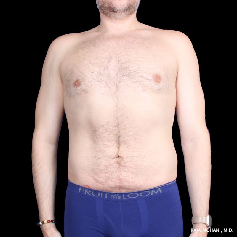 Liposuction Before & After Gallery - Patient 100759 - Image 54