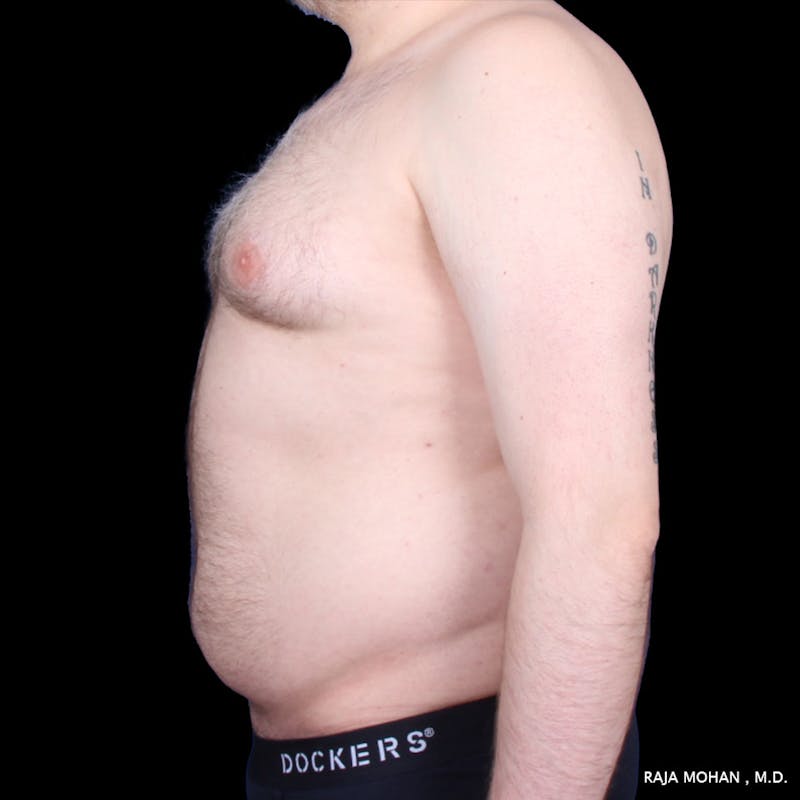 Liposuction Before & After Gallery - Patient 100759 - Image 55