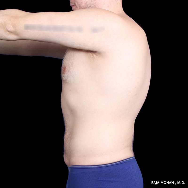 Liposuction Before & After Gallery - Patient 100759 - Image 56