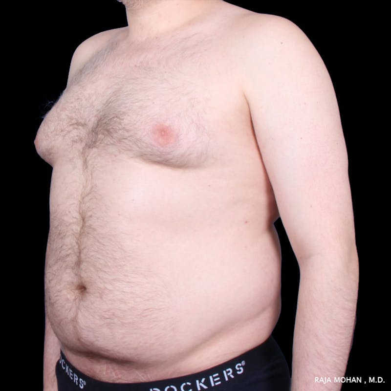 Liposuction Before & After Gallery - Patient 100759 - Image 57
